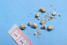 7-day Kidney Stone Diet - Prevention and Treatment