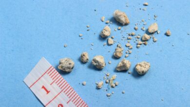 7-day Kidney Stone Diet - Prevention and Treatment