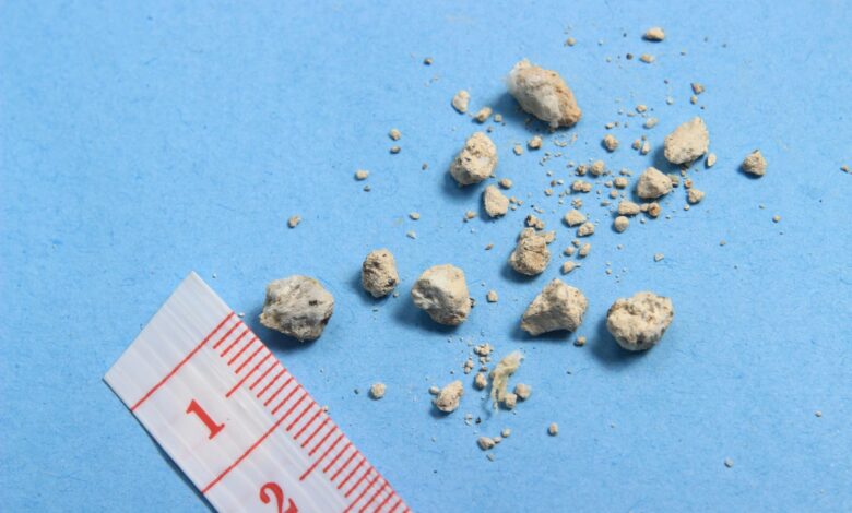 7-day Kidney Stone Diet - Prevention and Treatment